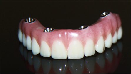 Fixed Implant-Supported Prostheses | Prosthodontist in Fresno, CA